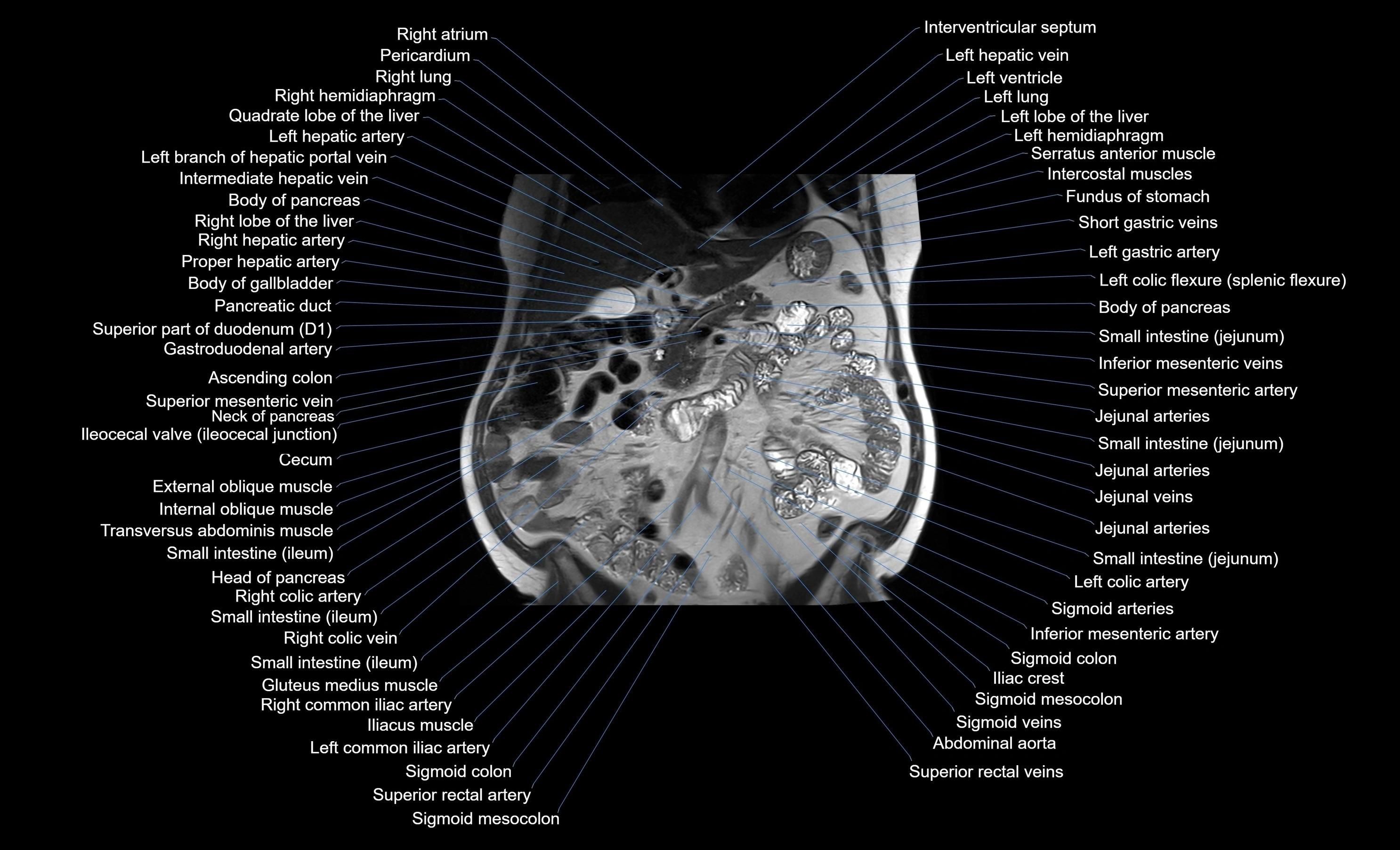MRI Abdomen coronal labelled cross sectional anatomy radiology  image-img-00001-00026.webp